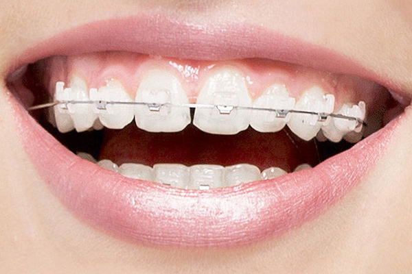 clear aligners australia